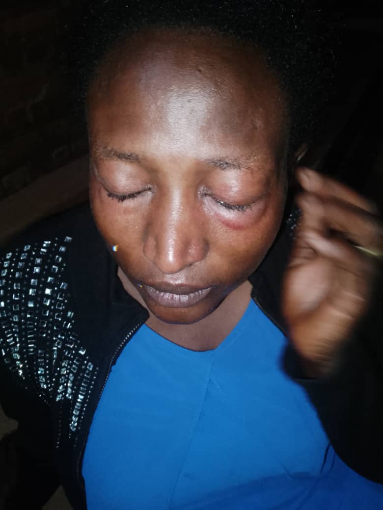 Uwizeyimana Justine avuga ko yavuye kwa muganga bakamubwira ko ijisho ryangiritse cyane