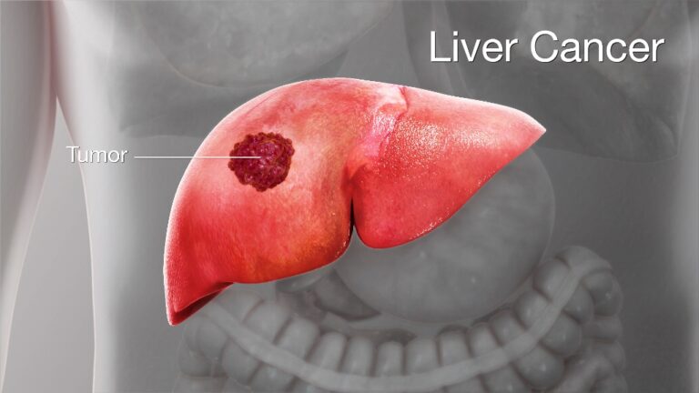 Liver-Cancer-FI